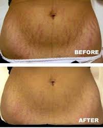 Bio Oil White Stretch Marks Before And After 6 Powerful Home Remedies For Stretch Marks That Really Work Stretch Mark Cream Stretch Mark Remedies Stretch Marks