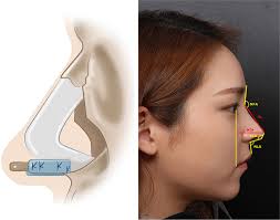 The current techniques in dorsal augmentation rhinoplasty: a comprehensive  review