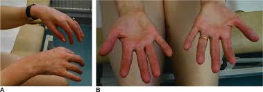 Image result for Myopathy
