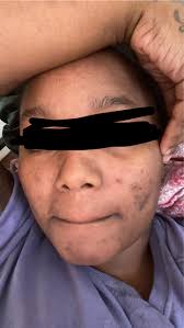 What are some things I can use to clear my face up with? My skin is very  dark and breaks out way too often and I tend to pick with it. What