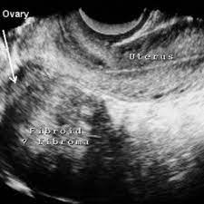 Rendered 3d Oblique Antero Posterior Transvaginal Ultrasound View Of Download Scientific Diagram