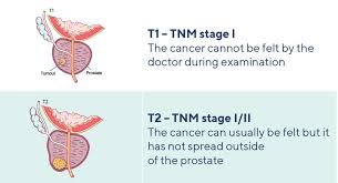 Image result for Prostate Cancer Staging