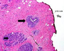 Having risk factors does not mean you will get breast cancer. Surgical Margins In Breast Conservation Sciencedirect