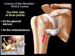 Listen to bastian hagl | soundcloud is an audio platform that lets you listen to what you love and share the sounds you create. Lesions Of The Shoulder Hagl Lesion Everything You Need To Know Dr Nabil Ebraheim Youtube