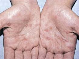 Image result for Secondary Syphilis