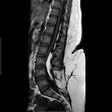 Image result for Spinal Dysraphism