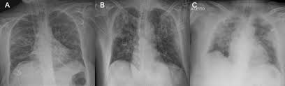 Chest X Ray In New Coronavirus Disease 2019 Covid 19 Infection Findings And Correlation With Clinical Outcome Springerlink