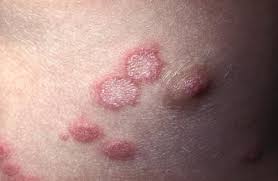 Clinical Forms Of Dermatophytosis Ringworm Infection Springerlink Ringworm commonly affects arms and legs, but it can appear almost anywhere on the body. dermatophytosis ringworm infection