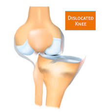 The blocks were connected with two large screws. Dislocated Knee Conditions Treatments Total Ortho Center