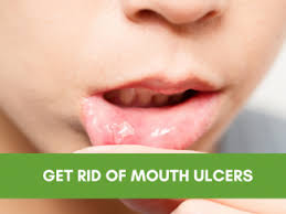 Image result for mouth ulcer on tongue)