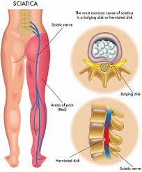 18 common causes of low back pain. Nyc Lower Back Pain Treatment Doctor Specialist Sports Injury Clinic In New York