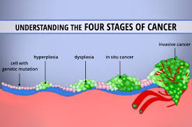 Doctors use several factors to classify cancer stage, including the size and locations of tumors. Understanding The 4 Stages Of Cancer