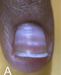 Image result for Muehrcke Line