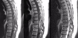 Image result for Spinal Epidural Abscess