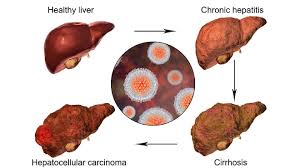 Our study aims to compare the diagnostic performance of conventional and. Stage 4 Bladder Cancer Treatment Onco Com