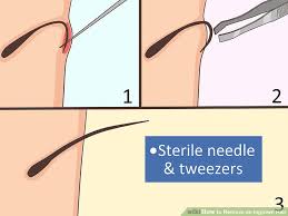 Sea salt has many functions, from exfoliating the skin to increasing the blood circulation for reducing swelling and quickening up the healing process. Ingrown Hair How To Remove Ingrown Hair Bumps On Face