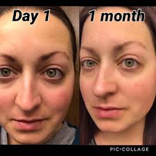 👀Take a look at her results after using Neo-Filler for 90 days. 🤯 And  that's after using Neora skincare for some time! 😍 (Go ahead zoom in) No  models, real people getting
