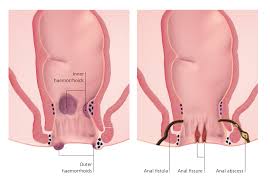 Image result for hemorrhoids
