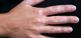 Maybe you would like to learn more about one of these? Ù…Ø±Ø§Ø­Ù„ Ø´ÙØ§Ø¡ Ø§Ù„Ø¨Ù‡Ø§Ù‚ ØªØ¹Ø±Ù Ø¹Ù„ÙŠÙ‡Ø§