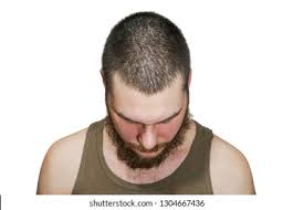 Hair loss in young men is something that is less common, but definitely happens. Young Man Worry Hair Loss Problem Stock Photo Edit Now 1304667436