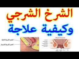 الشرخ الشرجي الاسباب الاعراض والعلاج Youtube