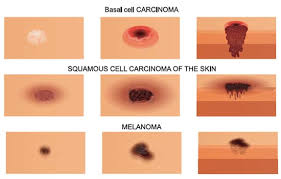 Often, the first stop is the lymph nodes. Spotting Skin Cancer Union Health Center