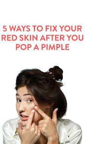 5 Ways To Care For Your Skin After Popping A Pimple Beauty Skin Beauty Hacks Skin