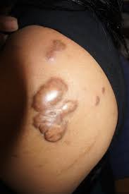Image result for Keloid