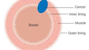 In general, iron deficiency anemia doesn't cause noticeable symptoms. Bowel Cancer Awareness Month Know About The Causes And Symptoms Of The Disease Latestly