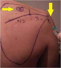 A cervical epidural steroid injection may be performed to reliev. A Prospective Comparative Study Of Subacromial Corticosteroid Injection And Subacromial Corticosteroid Injection Plus Suprascapular Nerve Block In Patients With Shoulder Impingement Syndrome Springerlink