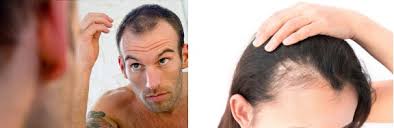 Masalah rambut gugur ini boleh dihindarkan dan dipulihkan dengan beberapa cara dan kaedah. 8 Punca Rambut Gugur Toppik Malaysia