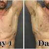 It's best to trim your back hair with a body groomer, since the back so easily breaks out with a shave. 1