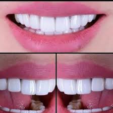 We did not find results for: Pasang Gigi Palsu Dan Behel Berkualitas Home Facebook