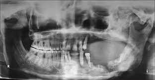 Jaw osteosarcoma (jos) is rare and it differs from other os in terms of the time of occurrence (two we concomitantly developed orthotopic pdx models of jaw osteosarcoma in scid mice, which, to. Parosteal Osteosarcoma Of Mandible A Rare Case Report Gupta S Parikh S Goel S J Can Res Ther