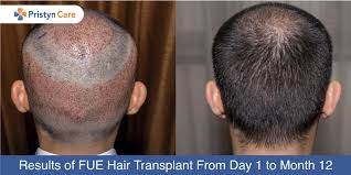 The complete results of the procedure are almost always visible fully after one year. Fue Hair Transplantation Resul Day 1 To Month 12 Pristyn Care