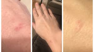 Image result for Bat Bite