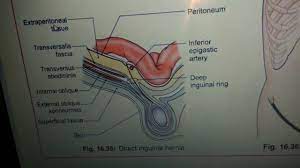 This may include pain or discomfort especially with coughing, exercise, or bowel movements. Inguinal Hernia Anatomy In Easy Way Youtube
