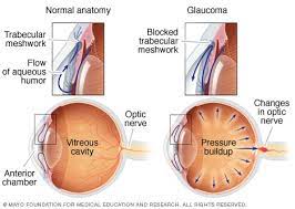 Learn about the types of glaucoma and whether you are. Glaucoma Symptoms And Causes Mayo Clinic