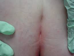 Image result for Pilonidal Cyst