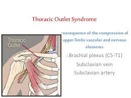 Thoracic Outlet Syndrome Thoracic Brachial Syndrome