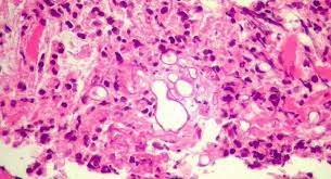A doença causa a morte em 50% das infecções, sendo necessário submeter o paciente à cirurgia para retirar a parte afetada pelo fungo. 35zyzm52yiiidm
