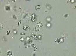 Calcium oxalate dihydrate in urine. Oxalate De Calcium Diamond Earrings Convenience Store Products Diamond