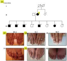 Image result for Koilonychia feet