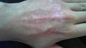 People with eczema have a hard time keeping their skin moist naturally, so it's important to use heavy moisturizers like petroleum jelly to trap in moisture. Hypopigmentation Causes Risk Factors Treatments More