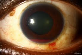 Image result for Hyphema