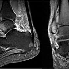 Friend subscribe my channal #the anatomy.for improve your basic anatomy.its really helpful for understanding because it is easy.by watching our vedio i am. T2 Mri Images Showing High Signal In Medial Malleolus Lateral Download Scientific Diagram