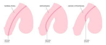 Image result for Chordee