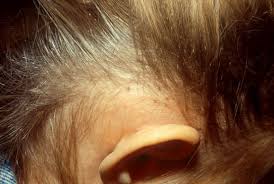 Read on for descriptions and photos of nits, plus detailed instructions on how to check your child's head nits are pale in color. What Does Lice Look Like Photos Info On Head Body Pubic Lice Health Com