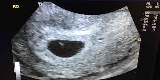 6 Week 1 Day Ultrasound 13mm Sac No Fetal Pole No Yolk Sac Could It Be Ok Netmums