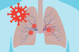 Here's the Damage Coronavirus (COVID-19) Can Do to Your Lungs ...